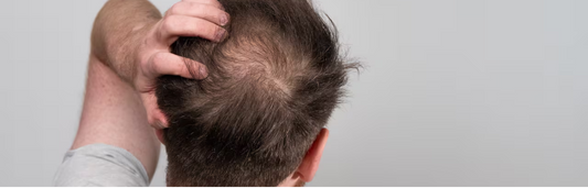 Alopecia androgénética