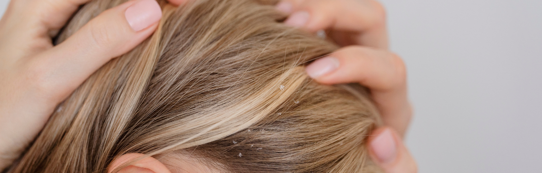 Dermatitis seborreica del cuero cabelludo: causas, síntomas y tratamie