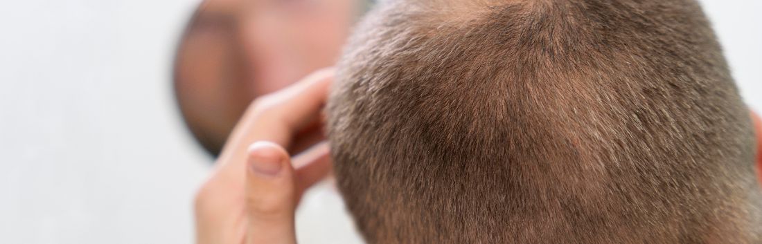 El mejor tratamiento anticaída para el pelo en hombres